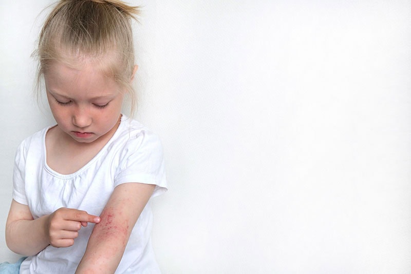 young girl scratching an allergic reaction on her arm.